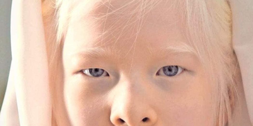 A baby girl born with albinism was abandoned by her parents. She looked too “strange” for them and left her at an orphanage door. Try not to smile when you see her today