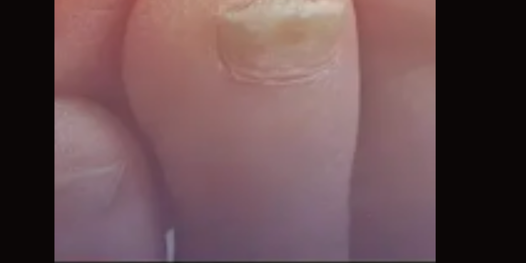 Causes and Treatments for Thick Toenails