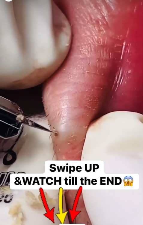 ST. New: Watch the Relax with Squeeze Acne Video