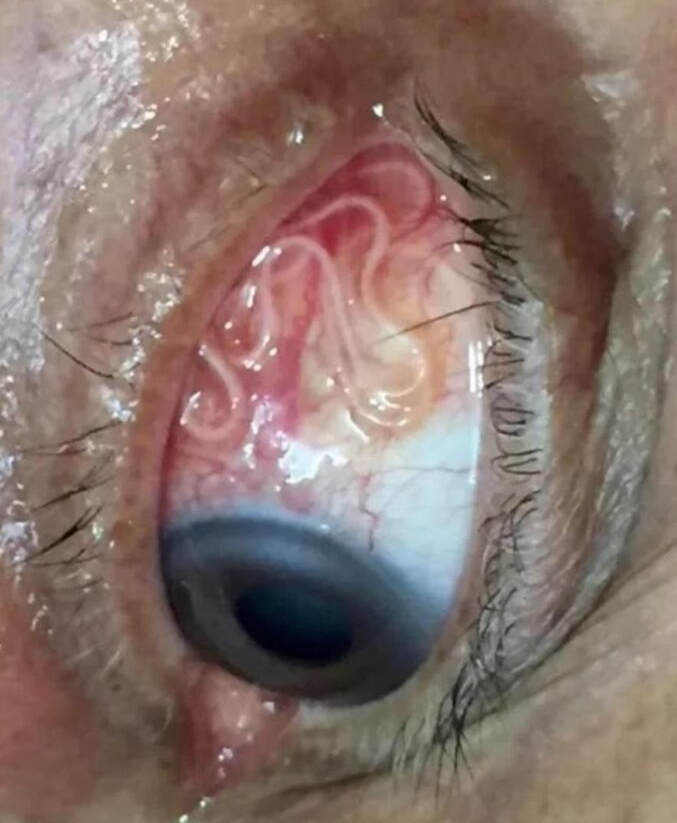 The Essentials of Eye Health: How to Prevent Infections