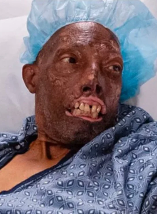 Journey to Healing: The Historic First African-American Male Face Transplant